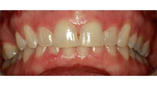 Gummy Smile – Gingival Laser Recontouring with Crowns and Bridges – Amy S. Before