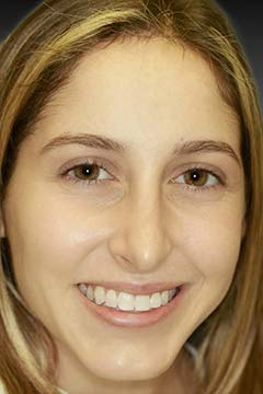 Gummy Smile – Gingival Laser Recontouring – Christina C. Headshot