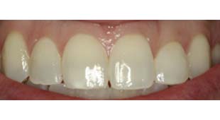 Gummy Smile – Gingival Laser Recontouring – Christina C. After