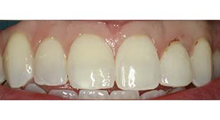 Gummy Smile – Gingival Laser Recontouring – Christina C. Before