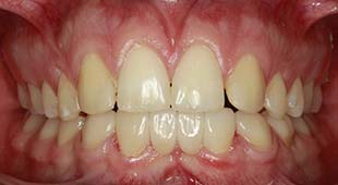 Loose / Missing Teeth – Bridges – Kevin H. After