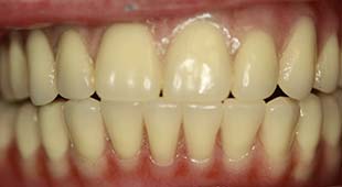 Uncomfortable Dentures / Partials – Bar Overdentures – Denise K. After