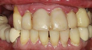 Uncomfortable Dentures / Partials – Bar Overdentures – Denise K. Before