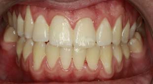 Crowded / Overlapping Teeth – Clear Aligners – Greg C. After