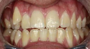 Crowded / Overlapping Teeth – Clear Aligners – Greg C. Before