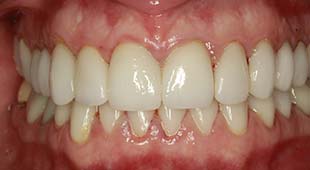 Yellow / Discolored Teeth – Crowns / Veneers – Jackie T. After