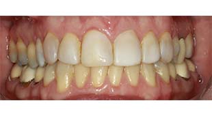 Yellow / Discolored Teeth – Crowns / Veneers – Jackie T. Before