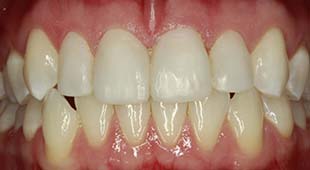 Yellow / Discolored Teeth – Crowns / Veneers – Jackie W. After