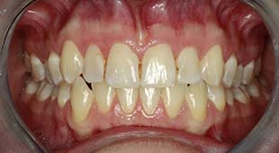 Yellow / Discolored Teeth – Crowns / Veneers – Jackie W. Before