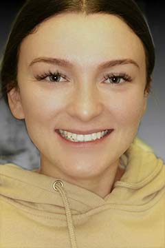 Yellow / Discolored Teeth – Crowns / Veneers – Jackie W. Headshot