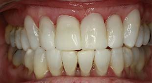 Yellow / Discolored Teeth – Whitening – Jane C. After