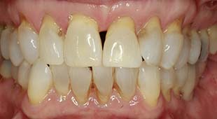 Yellow / Discolored Teeth – Whitening – Jane C. Before