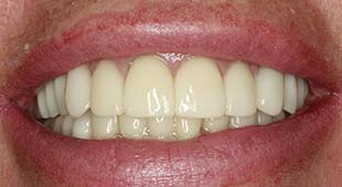 Yellow / Discolored Teeth – Crowns / Veneers – Lee C. After