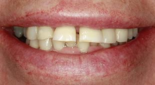 Yellow / Discolored Teeth – Crowns / Veneers – Lee C. Before