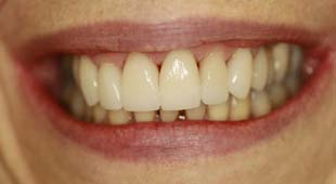 Crowded / Overlapping Teeth – Crowns / Veneers – Lisa M. After