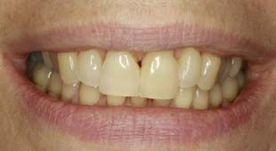 Crowded / Overlapping Teeth – Crowns / Veneers – Lisa M. Before