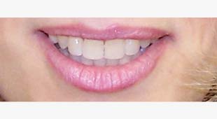 Spacing Between Teeth – Clear Aligners – Marianne W. After
