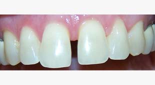Spacing Between Teeth – Clear Aligners – Marianne W. Before