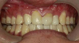 Bridges / Laser Recontouring – Nick M. Before