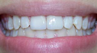 Chipped / Cracked Teeth / Bonding – Crowns / Veneers – Nicole M. After