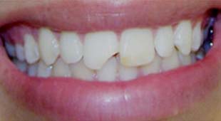 Chipped / Cracked Teeth / Bonding – Crowns / Veneers – Nicole M. Before