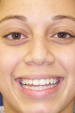 Chipped / Cracked Teeth / Bonding – Crowns / Veneers – Nicole M. Headshot