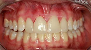 Spacing Between Teeth – Crowns / Veneers – Sara R. After