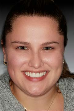 Spacing Between Teeth – Crowns / Veneers – Sara R. Headshot